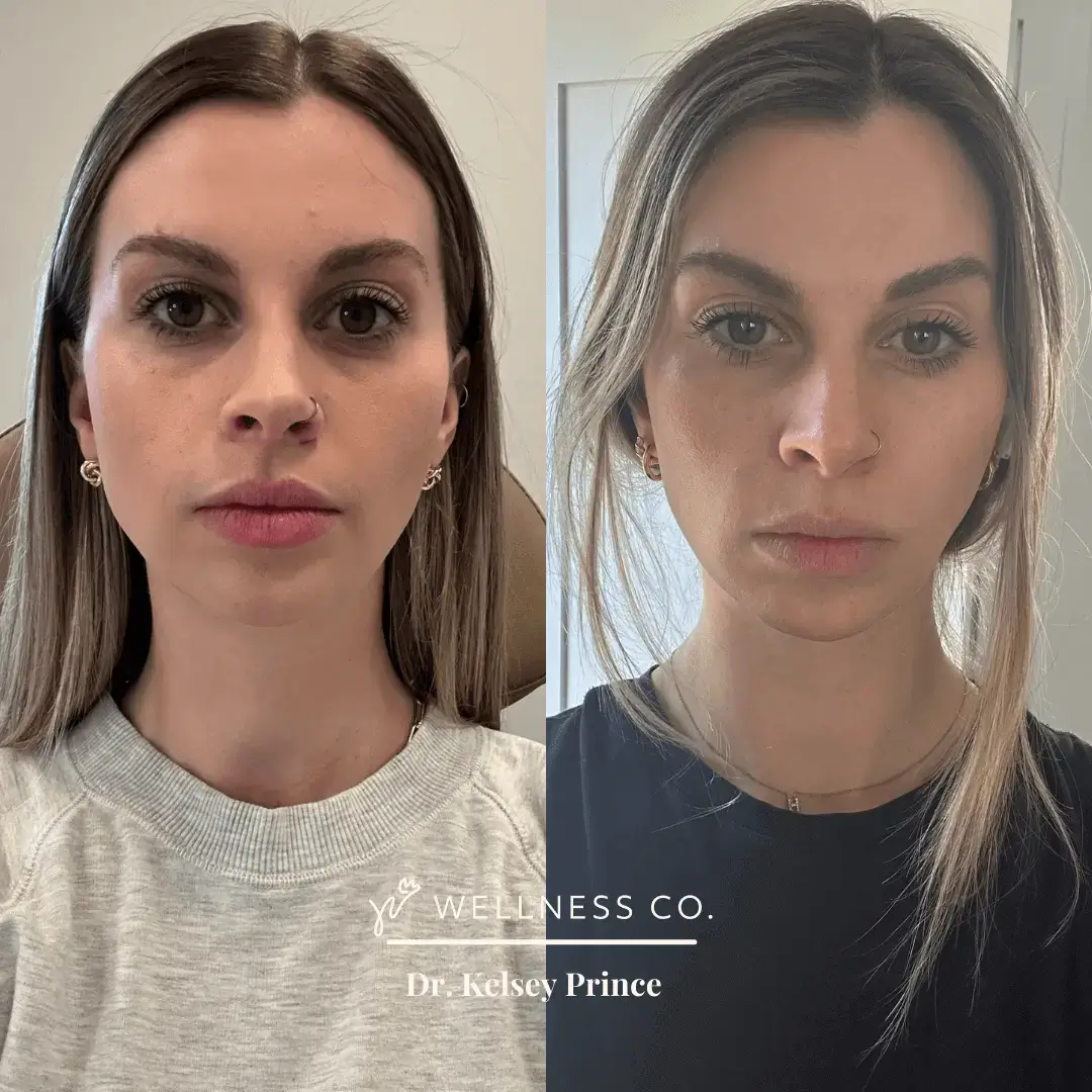 Botox-1.webp