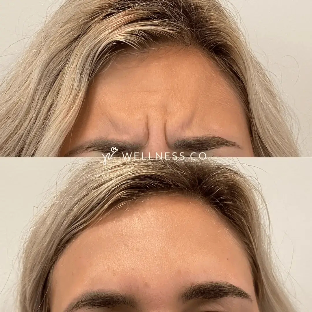 Botox-2.webp