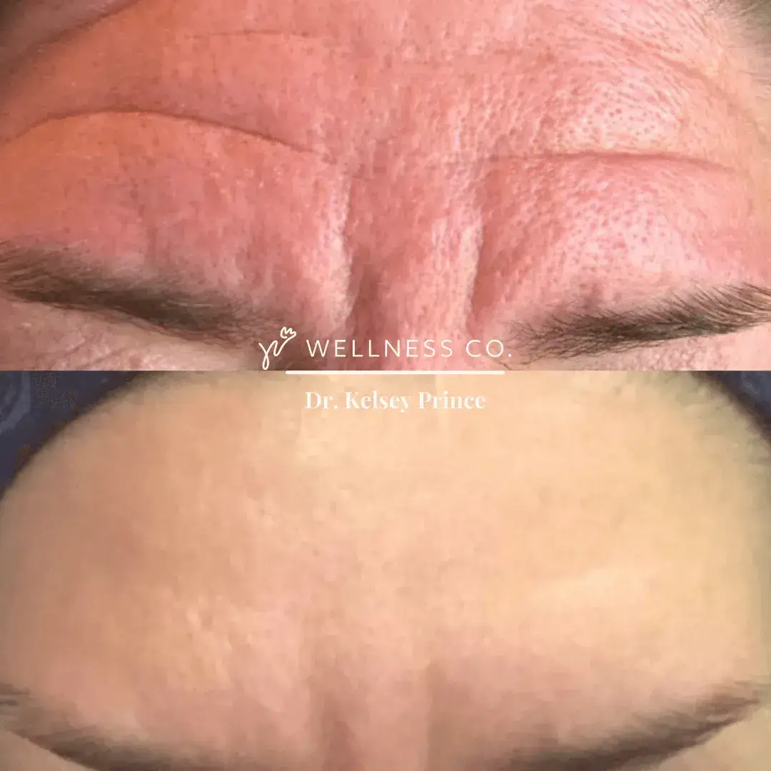 Botox-4.webp