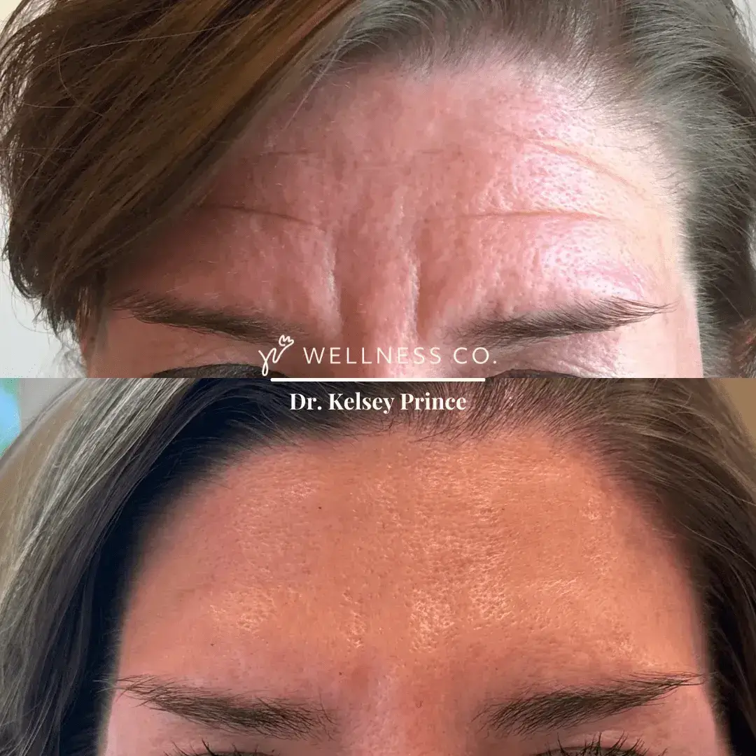 Botox-before-and-afters-1.webp
