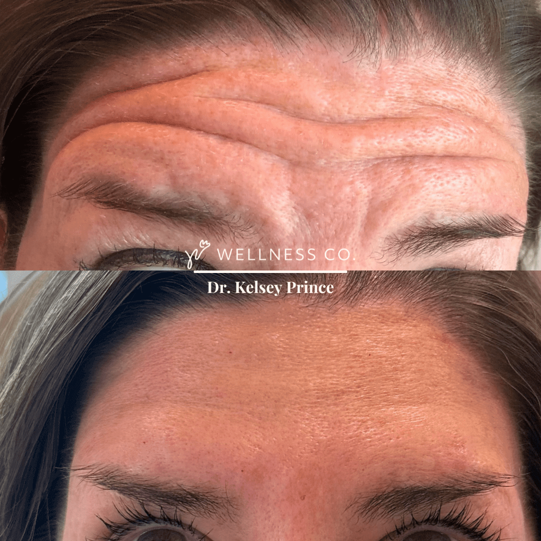 Botox-before-and-afters-3.png