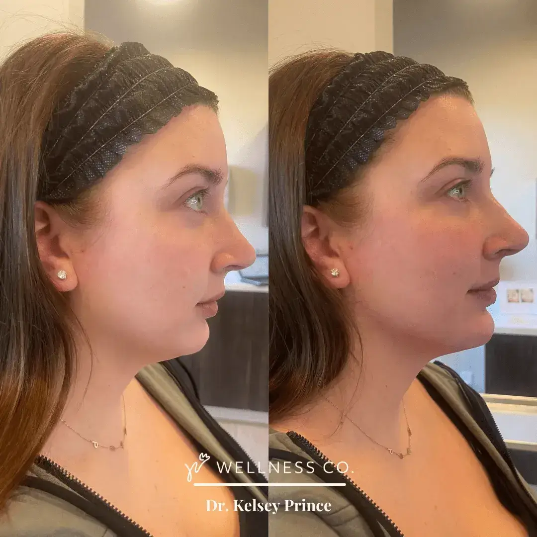 Dermal-Filler-90.webp