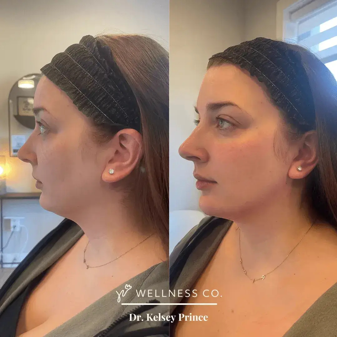 Dermal-Filler-91.webp