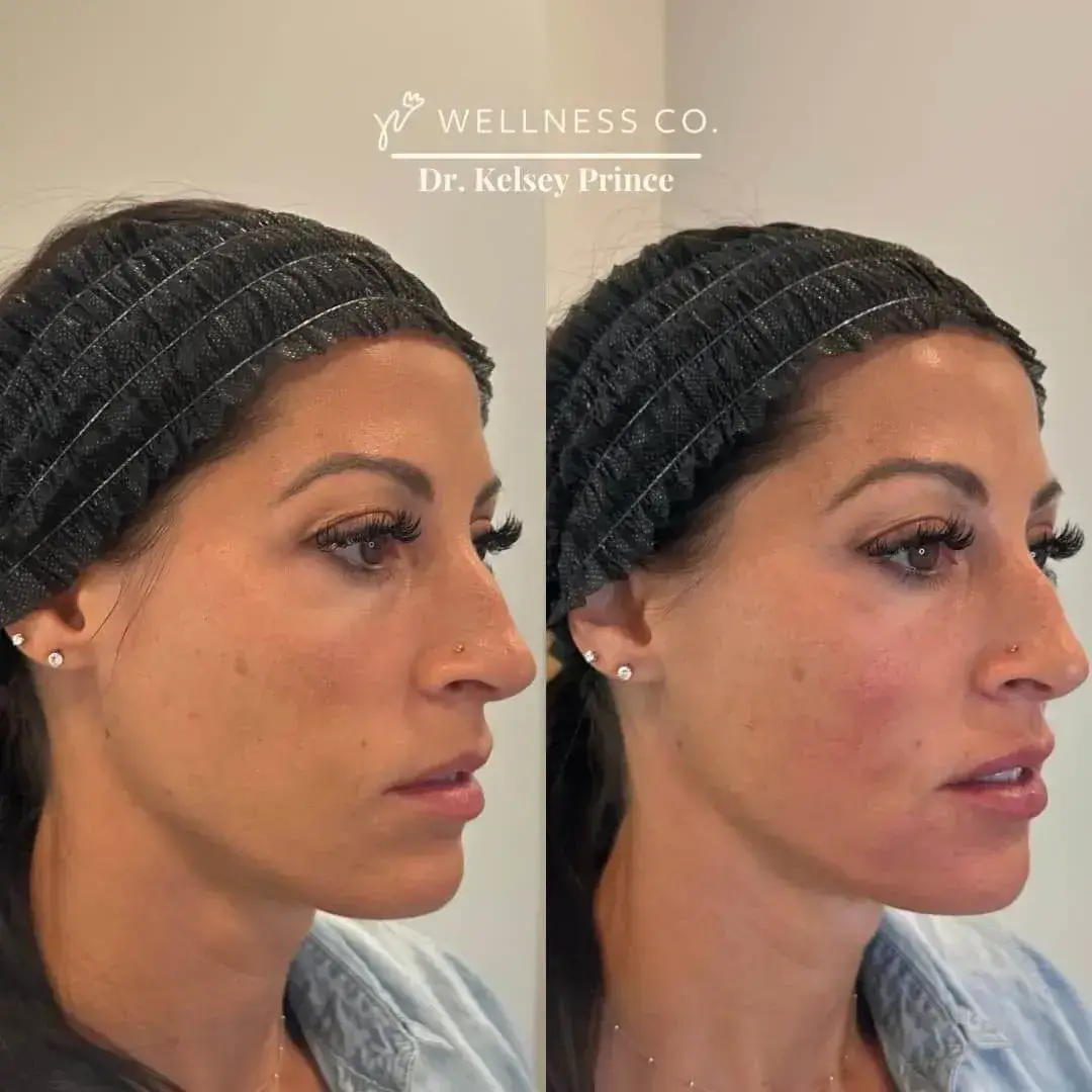 Dermal-Filler-For-Full-Face1.webp