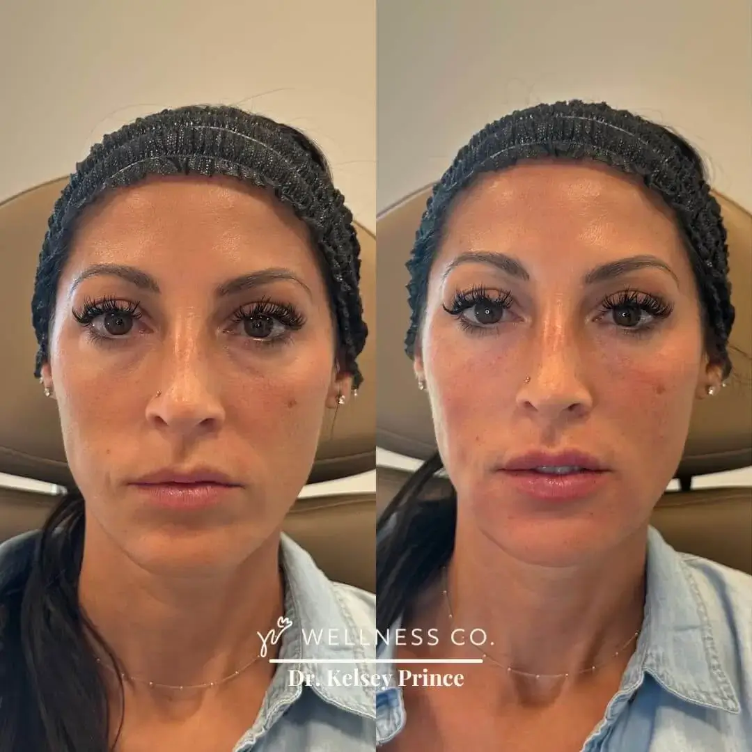Dermal-Filler-For-Full-Face13.webp