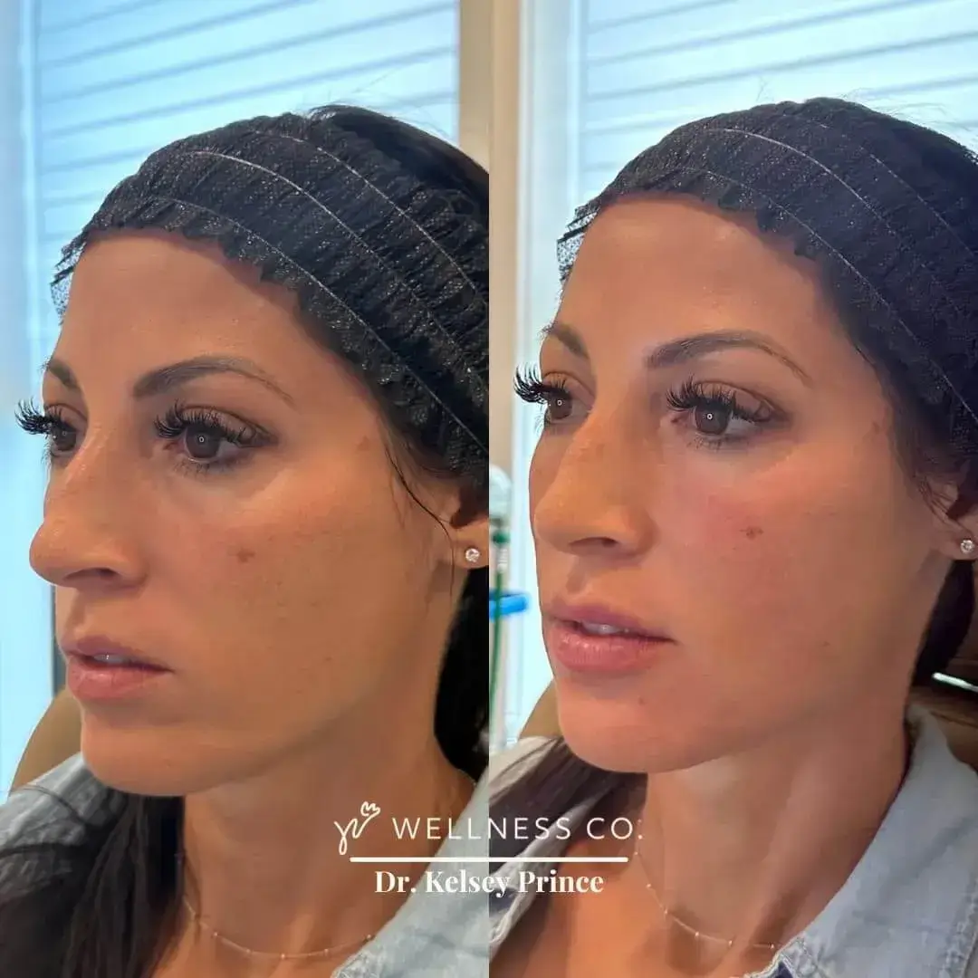 Dermal-Filler-For-Full-Face2.webp