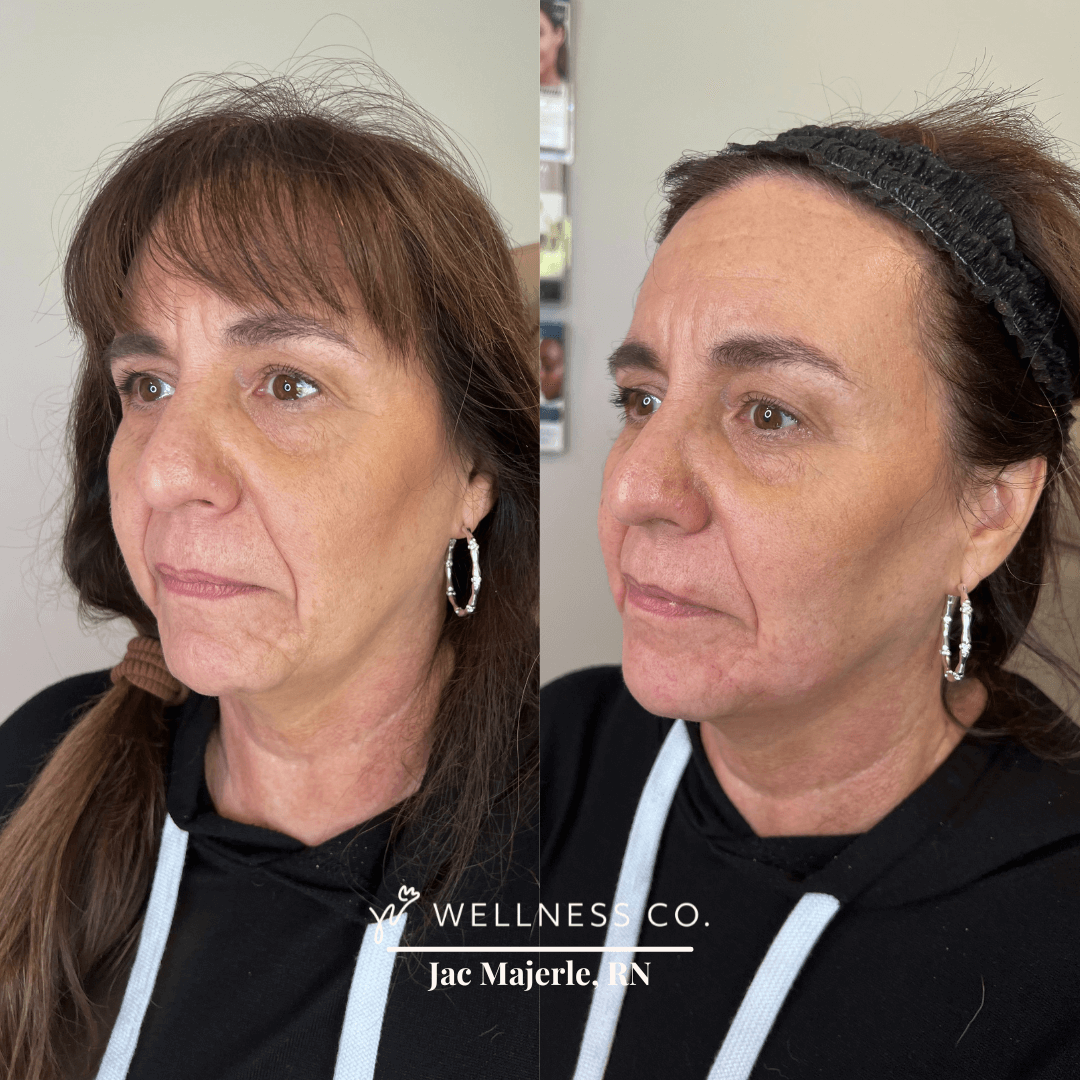 Dermal-Filler-for-Chin-Shadowing.png