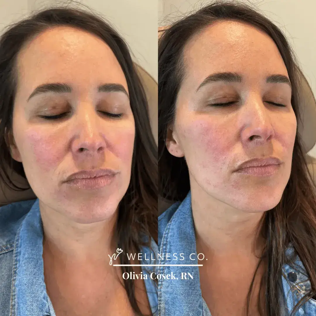 Dermal-Filler-for-Mid-face-1.webp