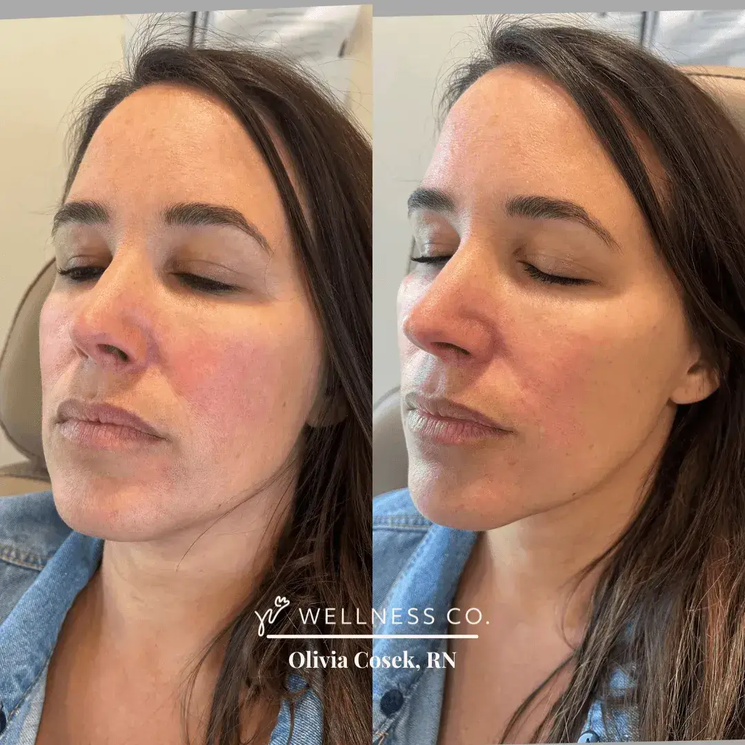 Dermal-Filler-for-Mid-face-2.webp