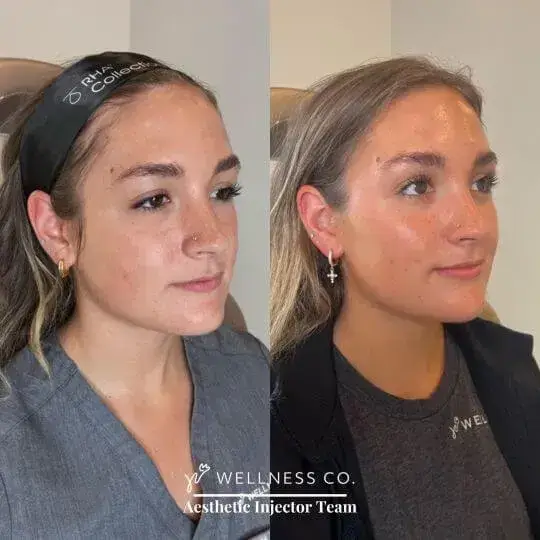 Dermal-Filler168.webp