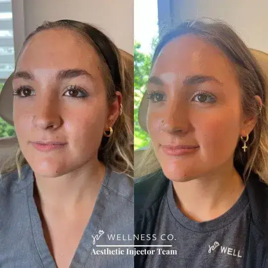 Dermal-Filler169.webp