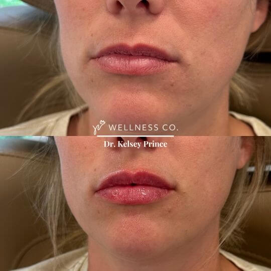 Lip-Filler-11.jpg