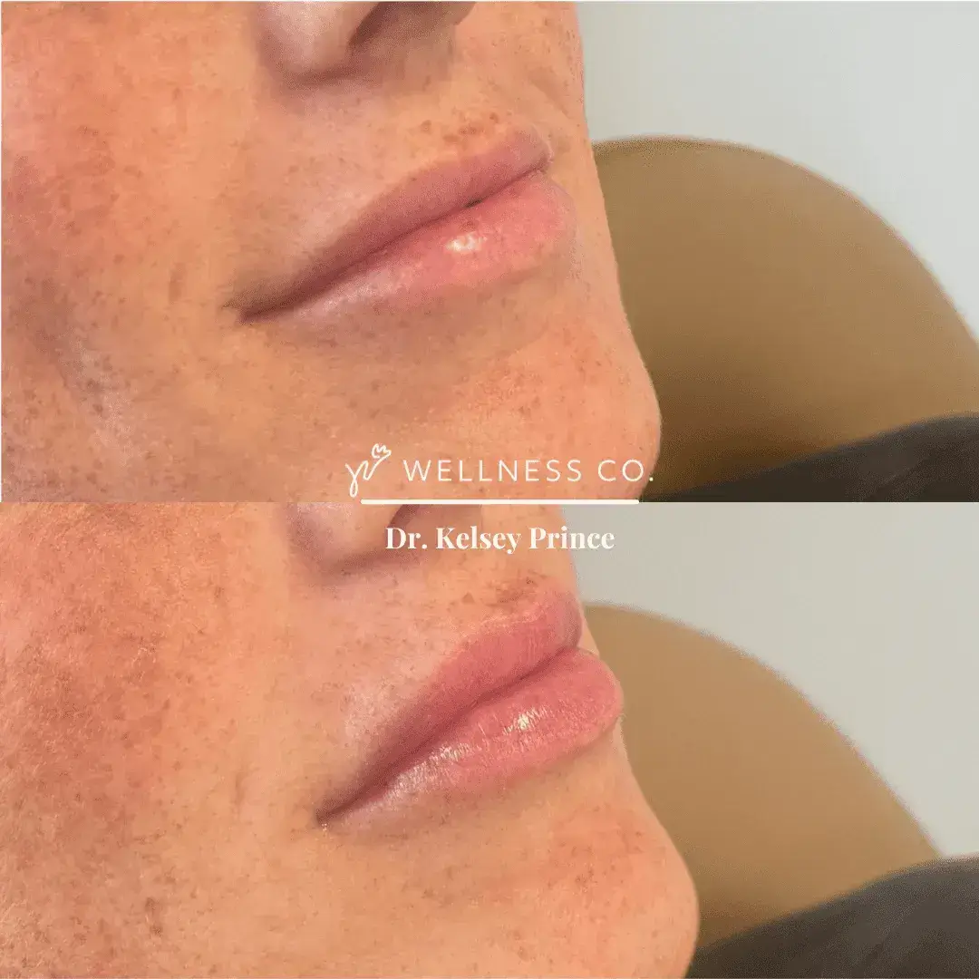 Lip-Filler-Before-and-After-1.webp