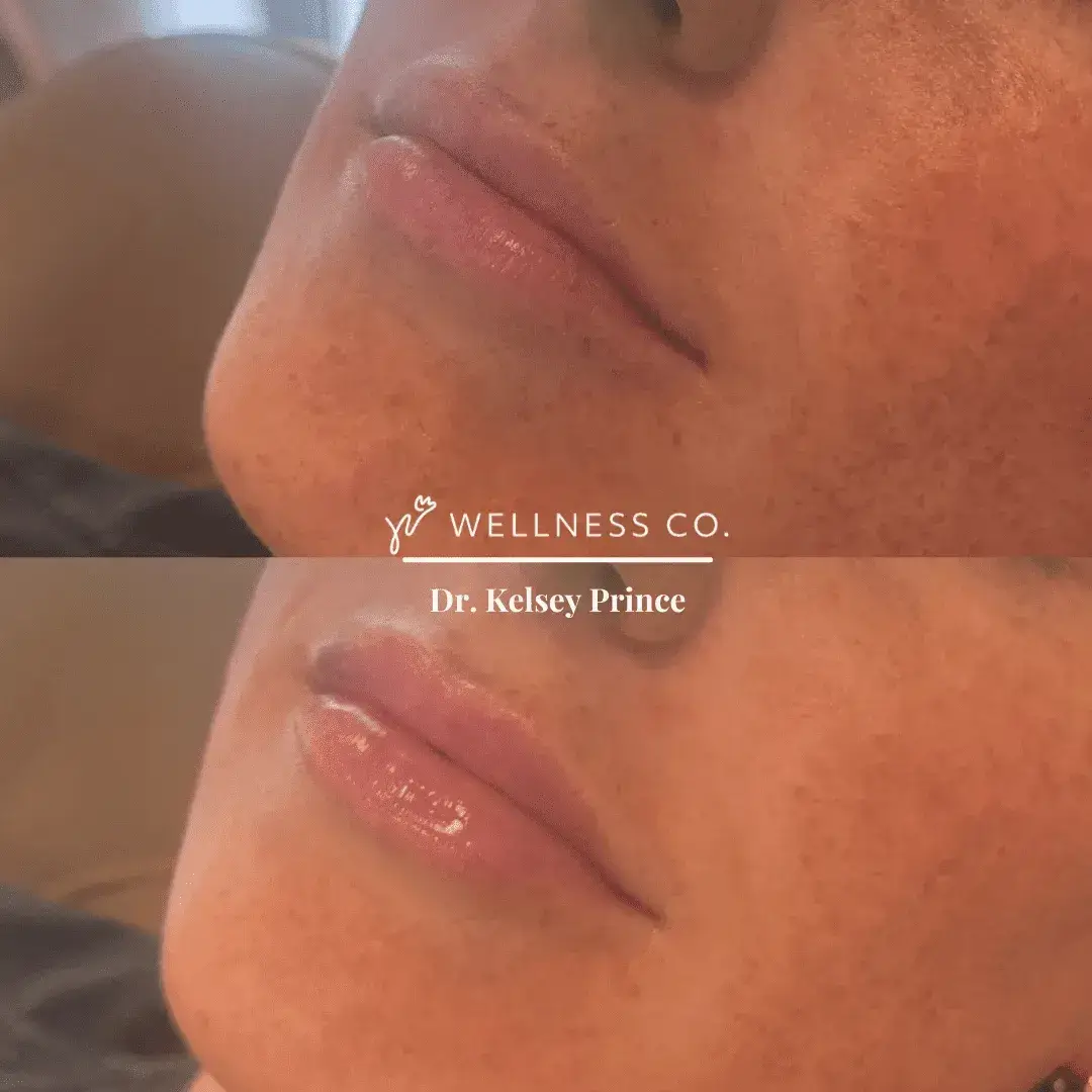 Lip-Filler-Before-and-After-2.webp