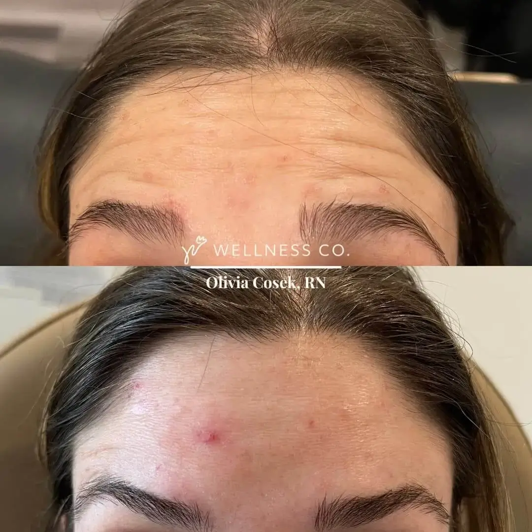 botox.webp