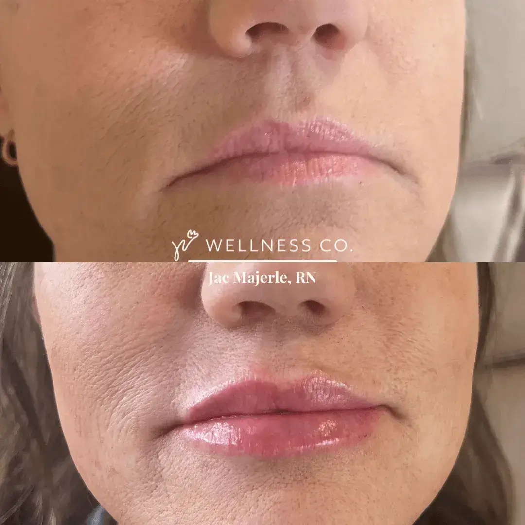 lip-filler.webp